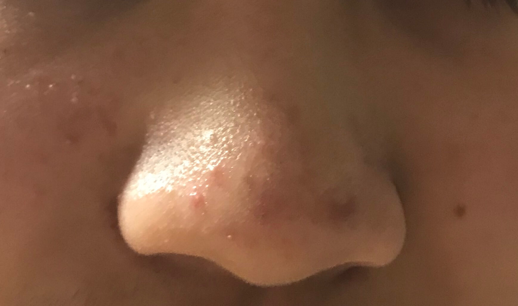 鼻と頬のニキビ写真